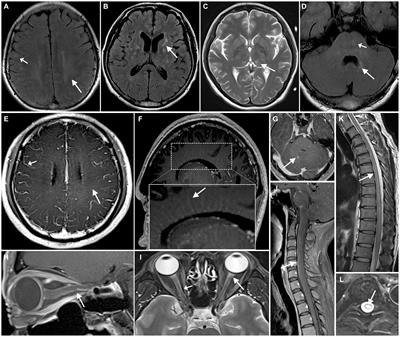 Clinical characteristics and MRI features of autoimmune glial fibrillary acidic protein astrocytopathy: a case series of 34 patients